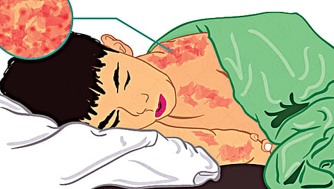 Measles : आता गोवरसाठी क्वारंटाईन! नाशिकमध्ये ‘इतके’ विलगीकरण कक्ष
