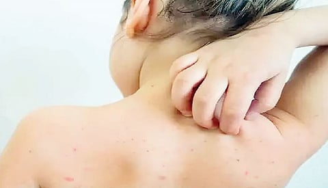 पुणे : घरीच प्रसूती होणार्‍या जिल्ह्यांत गोवरच्या उद्रेकाची शक्यता