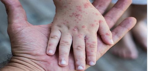 Measles outbreak | कोरोनानंतर जगभरात गोवरचा धोका का वाढला? WHO ने सांगितलं कारण