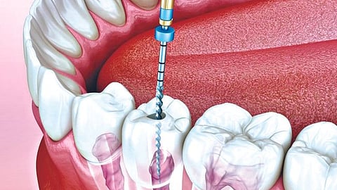 Root Canal 