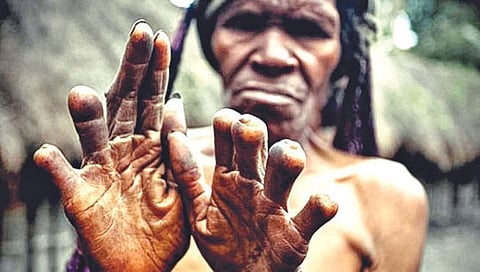 घरात मृत्यू झाला की, कापतात महिलांची बोटे; मृत पावलेली व्यक्‍ती भूत होऊन छळू नये म्हणूनची परंपरा