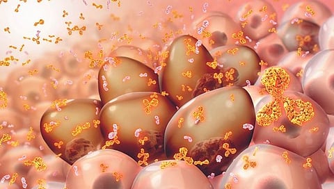 Multiple myeloma 