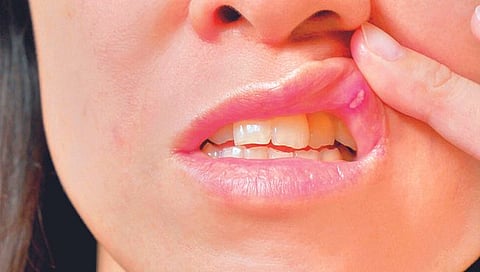 Mouth Sores : तोंड येण्‍याचा त्रास हाेताेय? वेळीच ‘हे’ उपाय करा