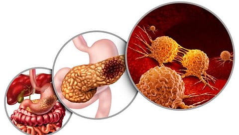 Pancreatic Cancer : पॅन्क्रिअ‍ॅॅटिक कॅन्सरच्या अंतरंगात…