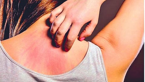 Allergy : काही पथ्ये पाळा,अ‍ॅलर्जीला टाळा! जाणून घ्‍या सविस्‍तर
