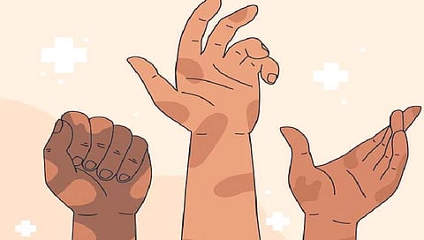 कोल्हापूर जिल्ह्यात नवे 68 कुष्ठरुग्ण; आरोग्य यंत्रणा हादरली