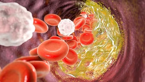 Cholesterol : हृदय तंदुरुस्त ठेवण्यासाठी ‘हे’ ४ उपाय करा, कोलेस्‍ट्रॉल राहील नियंत्रणात