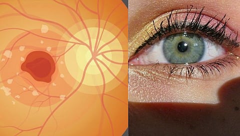 Macular Edema : मॅक्युलर एडिमा म्हणजे डोळ्याच्या रेटिनाला येणारी सूज; घ्‍यावयाची काळजी, लक्षणे अन् उपचार