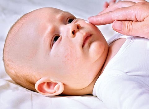 Baby Skin problem 