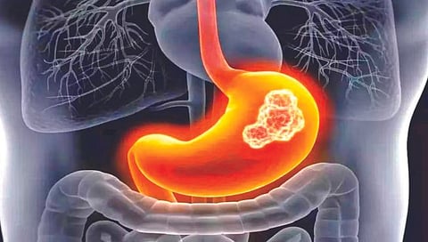 Stomach Cancer