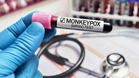 Monkeypox 