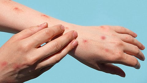 monkeypox 