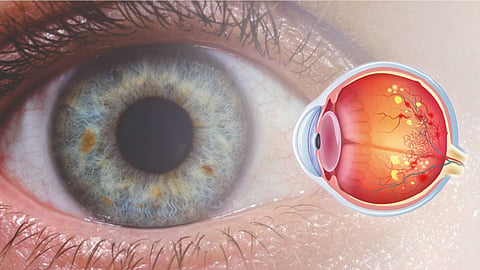 Diabetic Retinopathy Risk Youth