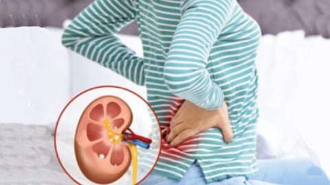 The risk of kidney stones increases during the summer