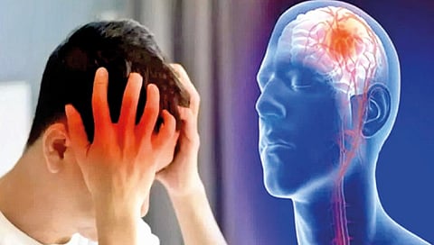 Brain stroke |