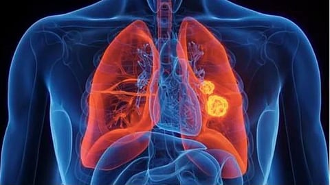 Pulmonary Embolism Treatment Goa