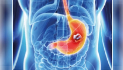 Stomach Cancer Symptoms