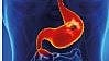 Ulcer treatment