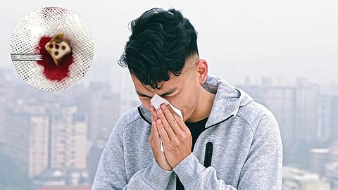 Chinese man discovers 20-year-old dice stuck in his nose after years of chronic sneezing