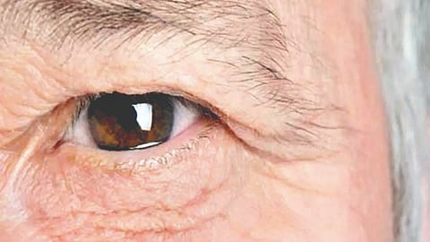 Eye disease