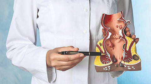 Hemorrhoids