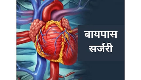बायपास सर्जरी 