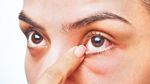 Eye diseases