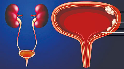 Bladder cancer
