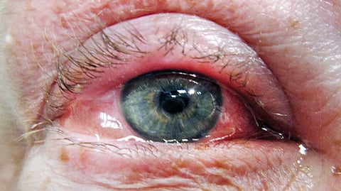 eyes Problem 