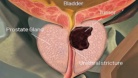 Prostate Cancer Symptoms and Treatment