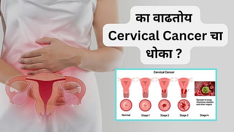 Cervical Cancer