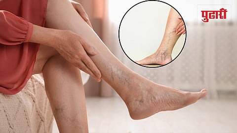 Varicose Veins