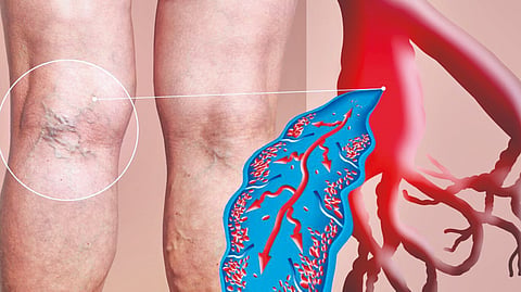 deep-vein-thrombosis