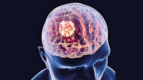 brain-tumor-symptoms-and-treatment-to-save-life