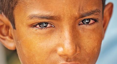 Eye Flu Cases