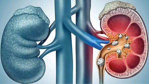 kidney stones complications