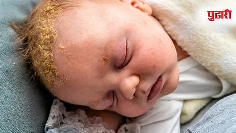Baby Fungal Infection 
