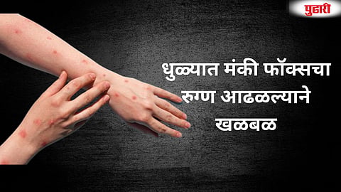 Dhule Monkeypox Case
