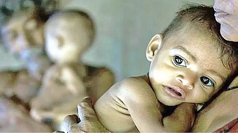65 Children Died Malnutrition