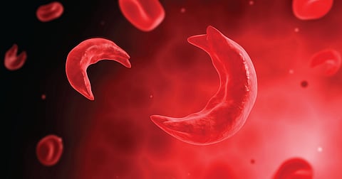 Sickle cell 