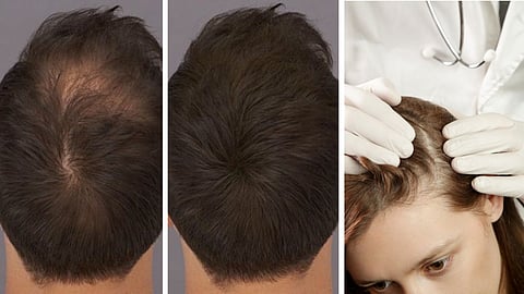 Hair Regrowth