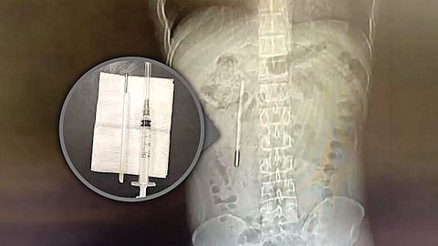 Swallowed thermometer medical case | 