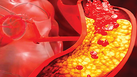 Heart attack prevention new drug | 