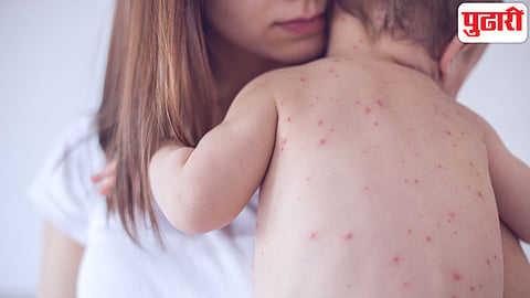 Bangladesh Measles