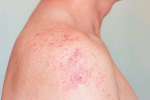Fungal infection |