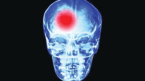 Heart rate stroke risk | 