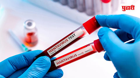Hantavirus Pulmonary Syndrome