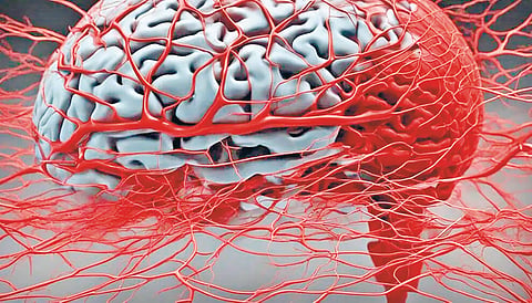 Serebral angiography |