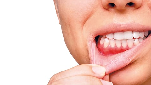 Gum disease |
