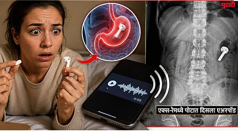 धक्कादायक! एका महिलेने औषध समजून  गिळला एअरपॉड, त्यानंतर तिच्या पोटातून  येऊ लागले व्हॉइस मेसेज